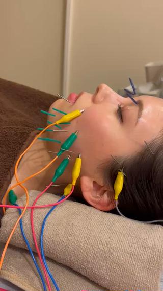 電気鍼で表情筋にダイレクトにアプローチ
衰えていた筋肉を呼び起こし、キュッと引き締まったフェイスラインに
でも刺激は心地よく、リラックスして寝てしまう方も…♡刺激量の調整もできますので初めての方でも安心して受けていただけます◎ 