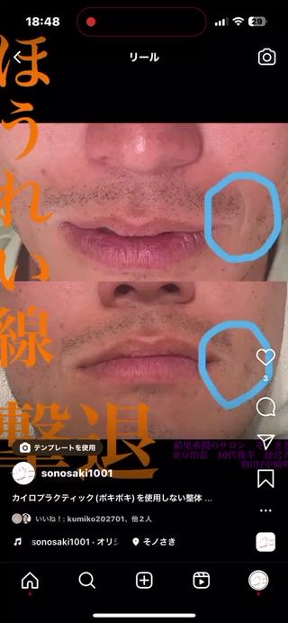 ほうれい線撃退