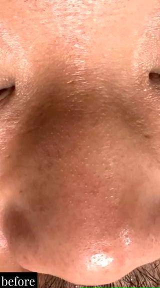 男性の頑固な角栓も1度でこんなにスッキリとなりました

#井高野
 #自宅サロン
 #エステ 
 #肌質改善 
＃艶肌
＃ハリ感
＃シワ改善
 #完全予約制
 #ハイドラ
 #毛穴洗浄
 #毛穴レス
 #ハイドラフェイシャル
 #ハイドラフェイシャルエステ
＃ゾンビマスク
 #パック
 #上新庄
 #IZM
 #ラッシュアディクト
 #リップアディクト
 #美容
 #こだわり
 #スキンケア
 #毛穴特化
 #オールハンドエステ
 #美容マニア
 #長女
 #姉妹
 #美容姉妹
 #メイク 