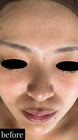 #井高野
 #自宅サロン
 #エステ 
 #肌質改善 
＃艶肌
＃ハリ感
＃シワ改善
 #完全予約制
 #ハイドラ
 #毛穴洗浄
 #毛穴レス
 #ハイドラフェイシャル
 #ハイドラフェイシャルエステ
＃ゾンビマスク
 #パック
 #上新庄
 #IZM
 #ラッシュアディクト
 #リップアディクト
 #美容
 #こだわり
 #スキンケア
 #毛穴特化
 #オールハンドエステ
 #美容マニア
 #長女
 #姉妹
 #美容姉妹
 #メイク 