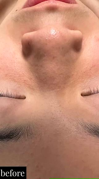 学生のお客様
思春期のニキビで悩んでる方にも施術できますよ*゜


#井高野
 #自宅サロン
 #エステ 
 #肌質改善 
＃艶肌
＃ハリ感
＃シワ改善
 #完全予約制
 #ハイドラ
 #毛穴洗浄
 #毛穴レス
 #ハイドラフェイシャル
 #ハイドラフェイシャルエステ
＃ゾンビマスク
 #パック
 #上新庄
 #IZM
 #ラッシュアディクト
 #リップアディクト
 #美容
 #こだわり
 #スキンケア
 #毛穴特化
 #オールハンドエステ
 #美容マニア
 #長女
 #姉妹
 #美容姉妹
 #メイク 