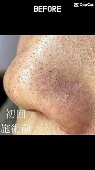 定期的なお手入れを続ける事で、毛穴レス肌に♪（動画は初回のビフォーと、5回目のビフォーです！どちらも施術前！） 