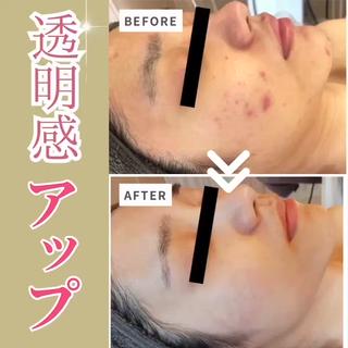 ブライトアップ(美白)コース
肌荒れでお悩みの方
お気軽にご相談ください 
