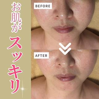 1回の効果です
たるみやほうれい線が気になる方へ
 