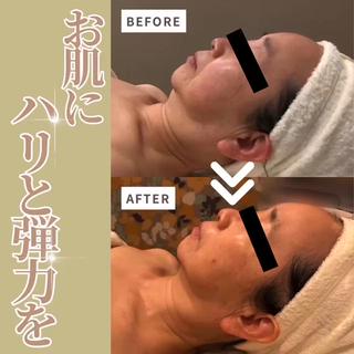 たるみ、ほうれい線など気になる方へ 