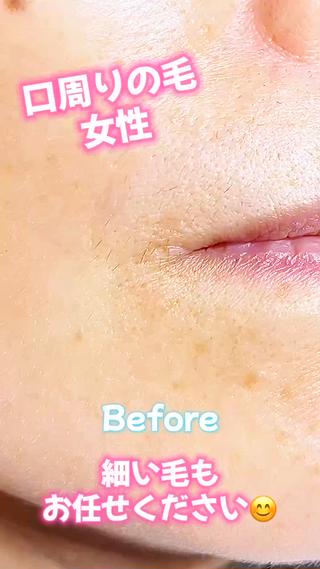 女性 口周りの毛 美容電気脱毛（ニードル脱毛） 