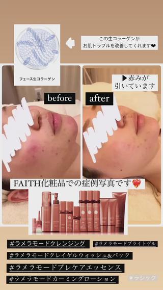 こんにちは
Dione栄店でございます
Dioneで取り扱っている化粧品FAITHでの症例写真です
お肌の赤みを引く鎮静効果はもちろんしっかりとお肌の改善もしてくれます
この時期、花粉や乾燥でお肌が荒れやすい季節となってるので是非まだ試した事が無い方は一度使って見て下さい
当店スタッフも実際ホームケアとして使用しておりリピーターです