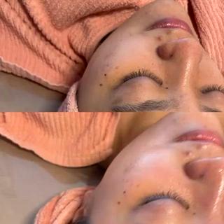 白玉スキンピーリングで艶肌
シミ・そばかす・ニキビ・ニキビ跡・毛穴などに！ 