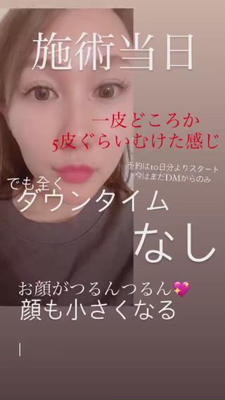 大人気！その日に全て剥けるハープピーリング。痛みなし・ダウンタイムなし！ 