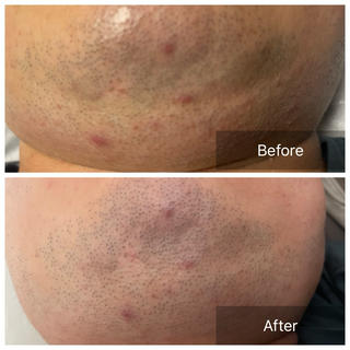 REVI 陶肌トリートメントハーブピーリング
翌日での変化

ごつごつした赤いニキビですら翌朝には赤みも引いて
ニキビも小さく 