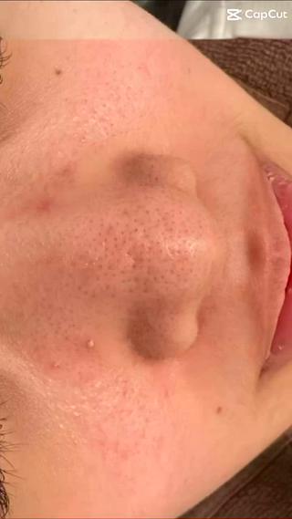 ️剥離無しハーブピーリング️
#毛穴ケア#毛穴レス#毛穴の黒ずみ