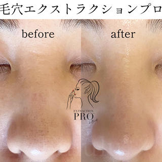 【拡大動画です　写真をタップで見れます！】
毛穴ひとつひとつをオールハンドで汚れを取り除いて行きます！
専用低刺激ローションを"エミューテ"を使用しています！


毛穴エクストラクションプロ認定サロン
︎毛穴専門店　Fululu （フルール）
おひとり様専用サロン
9:00〜17:00（最終受付15:00）

︎アクセス
神奈川県横浜市/
市営地下鉄グリーンライン日吉本町駅　
徒歩2分　
東横線日吉駅徒歩10分（急な坂があります！）
※プライベートサロンの為ご予約確定後場所をお知らせいたします 