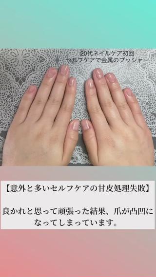 セルフの甘皮処理で爪を痛めてしまう場合もあります。良かれと思って頑張っていたらダメージになって歪になってしまったり。

 