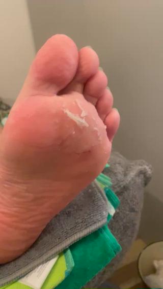 【角質ケア】
もともと足の裏にお怪我があったので怪我を庇って歩いていたので一部分に角質が溜まりました
そちらを今回は綺麗にさせて頂きました