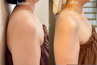 腋窩リンパ節(腋の下)をしっかり流せば、上半身が驚くほど変わります
↓次のような効果が期待できます↓
◎肩こり解消
◎二の腕の脂肪が落ちる
◎バストアップが期待できる
◎肌の新陳代謝が良くなり、美肌効果
◎疲労回復や免疫力アップが期待できる
脇下には老廃物を流し出すリンパ節や多くの血管があるため、リンパや血流を良くすることで、疲労物質や老廃物を溜めにくくすることができます。またリンパの流れが良くなることで、むくみが改善したり血行が促進されたりします。
体の側面はマッサージを受ける際に見落とされがちですが、当店では隅々まで流します他にはない手技を行なっておりますのでぜひご体感ください