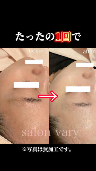 【ニキビ/肌管理】 salon varyのエステ・リラクイメージ