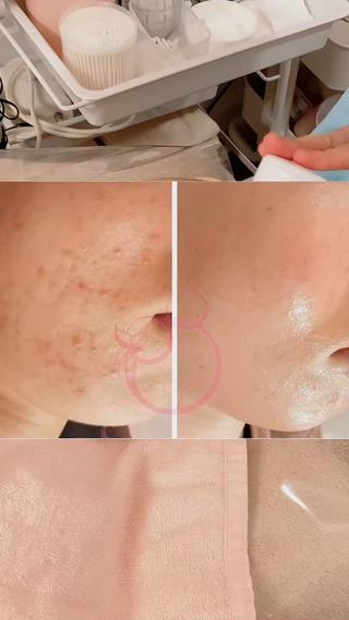 【ニキビ/肌管理】 salon varyのエステ・リラクイメージ