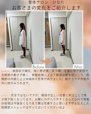 Before
頭の位置が前に出る「頭部前方偏位」と、強い巻き肩・反り腰・左重心がみられました。
その影響で足首の動きが悪く、骨盤が前に傾くことで下腹がぽっこり見える状態に。
さらに股関節の内旋により、末端の冷えも出ていました。
膝から下は外旋方向へのねじれがあり、全体のバランスが崩れていました。

After
施術後は頭の位置が整い、巻き肩が軽減。お腹にも力が入りやすくなり、骨盤の前傾や反り腰の改善が期待できます。
肩甲骨の開きも「指4本分→3本分」に変化し、肩の高さも左右で整いました。
骨盤の高さも揃い、バランスの取れた姿勢に 