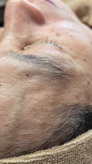 おでこからこめかみだけでもこんなに変化が！ 