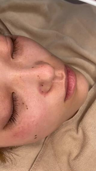 毛穴洗浄の様子です
こんな感じで汚れを吸引していきます!!
スッキリしますよ