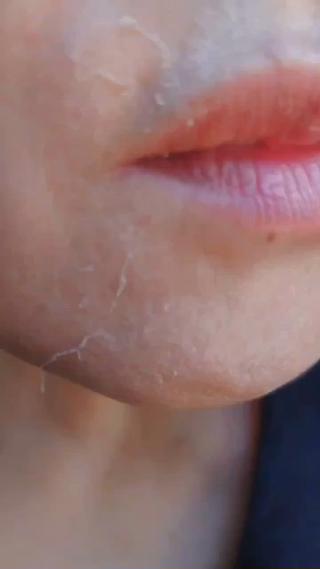 お客様が皮向けの様子を送ってくださいました5days 3日目の写真です。
皮向けには個人差があり、同じ人が同じ施術を受けても
その時の肌の状態や体調によって違ってきます。
不要な角質が無い方は剥けませんまた、肌の状態によってあまり剥けない場合もありますが、剥けなかったからといって効果が無いわけではありません。ハーブはしっかりと肌に働きかけています。

・リンパ液の循環を促進
・新陳代謝の正常化
・コラーゲン、エラスチンの再生
・皮膚のバリア機能強化（免疫機能強化）
・細胞の活性化

繰り返し施術を受けることで、見違えるほど健康で若々しいお肌へと導きます 