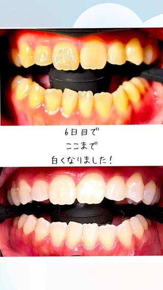 エナメル質だけでなく象牙質から白くなる医療ホワイトニング！
9割以上の方が痛みなく効果を実感！大手や歯科医院からの来店も多い特別な施術です。
「痛くて続けられない」「歯の色が気になる」「白い歯に憧れる」といったお悩みも、当サロンが解決します。
特別なジェルと歯科提携で、高品質なのに低価格。
歯科衛生士歴20年以上！完全個室でリラックスできます。
周りから「歯がキレイ」「若返った」と褒められる輝く白い歯を手に入れませんか？
美容室併設のトータルビューティサロン「歯科提携セルフダック宇都宮駒生店」へ、ぜひご相談ください。
アクセス： 栃木県宇都宮市駒生町1390-2 美容室tokinoma内 