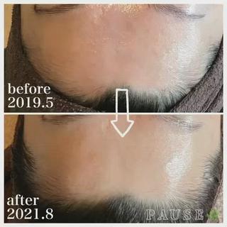 ⁡

乾燥肌解消
⁡
30代後半のお客様。
ご来店より2年3ヶ月目の
ビフォーアフターです︎
ホームケア中心のお客様ですが、
しっかり変化されています
⁡
カサカサ解消ツルツル肌に
シミそばかすも変化し続けています♬
⁡
サロンケア
#クイーンフィトセルトリートメント2回
#タラソトリートメント3回
⁡
ホームケア 
#クレアスキンリムーバー
#クレアスキンローション
#クレアスキンセラム
#クレアスキンステムクリーム
　
⁡
⁡
PAUSEポーズは、
【リアボーテ】・【リアムール】
正規認定サロンです。
⁡
オーナーの浜野が使用し、
安心・安全・効果・結果を
感じる事ができた商材・商品のみを
取り扱っております
⁡
お肌や頭皮、お身体のお悩みは、
お気軽にご相談ください
⁡
商品のご購入のみも承っております。
※リアボーテ・リアムール化粧品のご購入は、
対面カウンセリングが必要となります。
⁡
˗˗˗˗˗˗˗˗˗˗˗˗˗˗˗˗˗˗˗˗˗˗˗˗˗˗˗˗˗˗˗˗˗˗˗˗˗˗˗˗˗˗˗˗❀
⁡
アロマ＆エステ 
PAUSE-ポーズ-
⁡
【営業時間】
️平日:9時〜16時 ※金曜日は21時まで営業
️土日祝日:９時〜19時 ※土日祝日は、不定休
️定休日:水曜日
⁡
【ご予約・お問い合わせ】
️076-294-5778
公式ホームページ
https://hair-glean.com/este.html
⁡
˗˗˗˗˗˗˗˗˗˗˗˗˗˗˗˗˗˗˗˗˗˗˗˗˗˗˗˗˗˗˗˗˗˗˗˗˗˗˗˗˗˗˗˗˗˗˗˗˗˗˗˗˗˗❀
⁡
#リアボーテ#ボヌールエボーテ認定サロン
#ヒト幹細胞培養液エステ#無添加エステ#幹細胞コスメ#肌質改善#再生美容#クレアスキン#グランスキン#リアムール#無添加スキンケア#エステ#石川#野々市#金沢市#結果のでるエステ 