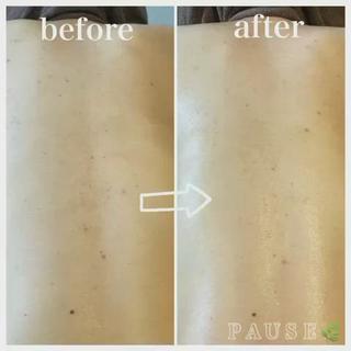 #リアボーテ
#背中ニキビケア
#ヒト幹細胞培養液エステ
⁡
タラソトリートメント5回目。
ニキビ跡にも変化が現れてまいりました
⁡
ホームケア
エキスパートトータルクレンジング
ホームケアに#リアムールエキスパートトータルクレンジング＆#リアムールトータルでバランスコンディションのご使用がおすすめです
ニキビ改善のスピードが違います
⁡
⁡
長年の肌トラブル、本気の肌質改善は
少しお時間がかかりますが
正しいお手入れをすれば
お肌は、変われます︎
⁡
本気の肌質改善、肌再生ケアを
求めている方はお気軽にご相談ください
⁡
⁡
背中ニキビケアメニュー
・
お肌の状態に合わせて4種類のエステより
組み合わせていきます。
※施術部位は、背中上部となります。
⁡
⁡
PAUSEポーズは、
【リアボーテ】・【リアムール】
正規認定サロンです。
⁡
オーナーの浜野が使用し、
安心・安全・効果・結果を
感じる事ができた商材・商品のみを
取り扱っております
⁡
お肌や頭皮、お身体のお悩みは、
お気軽にご相談ください

⁡
商品のご購入のみも承っております。
※リアボーテ・リアムール化粧品のご購入は、
対面カウンセリングが必要となります。
⁡
˗˗˗˗˗˗˗˗˗˗˗˗˗˗˗˗˗˗˗˗˗˗˗˗˗˗˗˗˗˗˗˗˗˗˗˗˗˗˗˗˗˗˗˗❀
⁡
アロマ＆エステ 
PAUSE-ポーズ-
⁡
【営業時間】
️平日:9時〜16時 ※金曜日は21時まで営業
️土日祝日:９時〜19時 ※土日祝日は、不定休
️定休日:水曜日
⁡
【ご予約・お問い合わせ】
️076-294-5778
公式ホームページ
https://hair-glean.com/este.html
⁡
˗˗˗˗˗˗˗˗˗˗˗˗˗˗˗˗˗˗˗˗˗˗˗˗˗˗˗˗˗˗˗˗˗˗˗˗˗˗˗˗˗˗˗˗˗˗˗˗˗˗˗˗˗˗❀
⁡
#リアボーテ#ボヌールエボーテ認定サロン
#ヒト幹細胞培養液エステ#無添加エステ#幹細胞コスメ#肌質改善#再生美容#クレアスキン#グランスキン#リアムール#無添加スキンケア#エステ#石川#野々市#金沢市#結果のでるエステ 