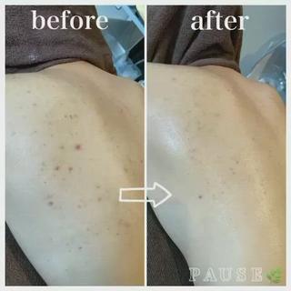 
#リアボーテ
#背中ニキビケア
#ヒト幹細胞培養液エステ
⁡
タラソトリートメント5回目。
ニキビ跡にも変化が現れてまいりました
⁡
ホームケア
エキスパートトータルクレンジング
ホームケアに#リアムールエキスパートトータルクレンジング＆#リアムールトータルでバランスコンディションのご使用がおすすめです
ニキビ改善のスピードが違います
⁡
⁡
長年の肌トラブル、本気の肌質改善は
少しお時間がかかりますが
正しいお手入れをすれば
お肌は、変われます︎
⁡
本気の肌質改善、肌再生ケアを
求めている方はお気軽にご相談ください
⁡
⁡
背中ニキビケアメニュー
・
お肌の状態に合わせて4種類のエステより
組み合わせていきます。
※施術部位は、背中上部となります。
⁡
⁡
PAUSEポーズは、
【リアボーテ】・【リアムール】
正規認定サロンです。
⁡
オーナーの浜野が使用し、
安心・安全・効果・結果を
感じる事ができた商材・商品のみを
取り扱っております
⁡
お肌や頭皮、お身体のお悩みは、
お気軽にご相談ください

⁡
商品のご購入のみも承っております。
※リアボーテ・リアムール化粧品のご購入は、
対面カウンセリングが必要となります。
⁡
˗˗˗˗˗˗˗˗˗˗˗˗˗˗˗˗˗˗˗˗˗˗˗˗˗˗˗˗˗˗˗˗˗˗˗˗˗˗˗˗˗˗˗˗❀
⁡
アロマ＆エステ 
PAUSE-ポーズ-
⁡
【営業時間】
️平日:9時〜16時 ※金曜日は21時まで営業
️土日祝日:９時〜19時 ※土日祝日は、不定休
️定休日:水曜日
⁡
【ご予約・お問い合わせ】
️076-294-5778
公式ホームページ
https://hair-glean.com/este.html
⁡
˗˗˗˗˗˗˗˗˗˗˗˗˗˗˗˗˗˗˗˗˗˗˗˗˗˗˗˗˗˗˗˗˗˗˗˗˗˗˗˗˗˗˗˗˗˗˗˗˗˗˗˗˗˗❀
⁡
#リアボーテ#ボヌールエボーテ認定サロン
#ヒト幹細胞培養液エステ#無添加エステ#幹細胞コスメ#肌質改善#再生美容#クレアスキン#グランスキン#リアムール#無添加スキンケア#エステ#石川#野々市#金沢市#結果のでるエステ 