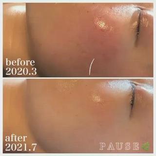 ⁡
⁡
40代前半のお客様。
ご来店より1年4ヶ月目の
ビフォーアフターです︎
⁡
赤ら顔
目元のたるみ
ほうれい線
諦めていたお悩み解消されました
⁡
サロンケア
1〜3ヵ月に1回のエステ。
クイーンフィトセルトリートメント、レストセルトリートメントをお肌の状態により施術。
ホームケア
2021.2〜
●エキスパートラッシュ
●アコライムCCクリーム
⁡
今回のメニュー
クイーンフィトセルトリートメント60分 
デコルテ・ドライヘッドスパ付き 
14300円(税込)
★初回トライヤル価格12100円(税込)
⁡
⁡
PAUSEポーズは、
【リアボーテ】・【リアムール】
正規認定サロンです。
⁡
オーナーの浜野が使用し、
安心・安全・効果・結果を
感じる事ができた商材・商品のみを
取り扱っております
⁡
お肌や頭皮、お身体のお悩みは、
お気軽にご相談ください
⁡
商品のご購入のみも承っております。
※リアボーテ・リアムール化粧品のご購入は、
対面カウンセリングが必要となります。
⁡
˗˗˗˗˗˗˗˗˗˗˗˗˗˗˗˗˗˗˗˗˗˗˗˗˗˗˗˗˗˗˗˗˗˗˗˗˗˗˗˗˗˗˗˗❀
⁡
アロマ＆エステ 
PAUSE-ポーズ-
⁡
【営業時間】
️平日:9時〜16時 ※金曜日は21時まで営業
️土日祝日:９時〜19時 ※土日祝日は、不定休
️定休日:水曜日
⁡
【ご予約・お問い合わせ】
️076-294-5778
公式ホームページ
https://hair-glean.com/este.html
⁡
˗˗˗˗˗˗˗˗˗˗˗˗˗˗˗˗˗˗˗˗˗˗˗˗˗˗˗˗˗˗˗˗˗˗˗˗˗˗˗˗˗˗˗˗˗˗˗˗˗˗˗˗˗˗❀
⁡
#リアボーテ#ボヌールエボーテ認定サロン
#ヒト幹細胞培養液エステ#無添加エステ#幹細胞コスメ#肌質改善#再生美容#クレアスキン#グランスキン#リアムール#無添加スキンケア#エステ#石川#野々市#金沢市#結果のでるエステ 