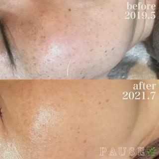 ⁡
⁡
⁡
40代のお客様。
ご来店より2年2ヶ月目の
ビフォーアフターです︎
⁡
シミに変化
シワに変化
小顔に！
⁡
【サロンケア】
#タラソトリートメント5回
#ハーブトリートメント5回
#ACトリートメント1回
⁡
【ホームケア】
#クレアスキンローション
#アコライムCCクリーム
⁡
今回のメニュー↓
タラソトリートメント90分 
デコルテ・ドライヘッドスパ付き 
⁡
⁡
PAUSEポーズは、
【リアボーテ】・【リアムール】
正規認定サロンです。
⁡
PAUSEでは、オーナーの浜野が使用し、
安心・安全・効果・結果を
感じる事ができた商材・商品のみを
取り扱っております。
⁡
商品のご購入のみも承っております。
リアボーテ・リアムール化粧品のご購入は、
対面カウンセリングが必要となります。
⁡
お肌やお身体のお悩みは、お気軽にご相談ください
⁡
●◯●◯●◯●◯●◯●◯●◯●◯●◯●◯●
⁡
アロマ＆エステ PAUSE-ポーズ-
⁡
【営業時間】
️平日:9時〜16時 ※金曜日は21時まで営業
️土日祝日:９時〜19時 ※土日祝日は、不定休
️定休日:水曜日
⁡
【ご予約・お問い合わせ】
️076-294-5778
公式ホームページ
https://hair-glean.com/este.html
⁡
●◯●◯●◯●◯●◯●◯●◯●◯●◯●◯●
⁡
#リアボーテ#ボヌールエボーテ認定サロン
#ヒト幹細胞培養液エステ#無添加エステ#幹細胞コスメ#肌質改善#再生美容#クレアスキン#グランスキン#リアムール#無添加スキンケア#エステ#石川#野々市#金沢市#結果のでるエステ 