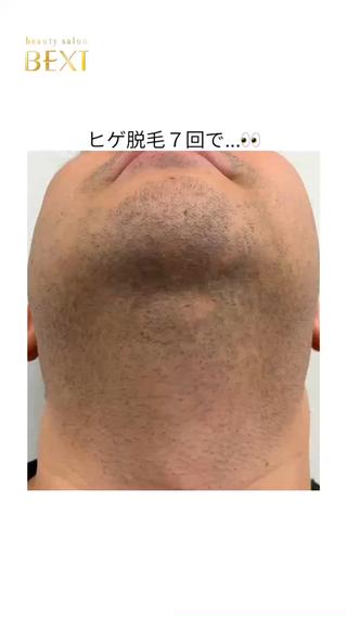 ヒゲ脱毛ビフォーアフター
#ヒゲ脱毛 #ヒゲ脱毛名古屋 #ヒゲ #メンズ脱毛名古屋 #青ひげ #脱毛名古屋 #脱毛中川