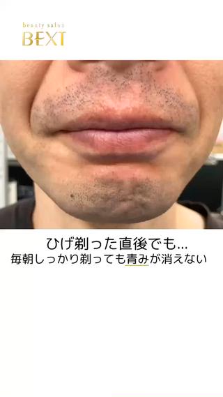 #ヒゲ脱毛 #名古屋脱毛 #メンズ脱毛 #名古屋メンズ脱毛 #名駅脱毛 #青ひげ #脱毛 #ひげ脱毛名古屋 #名駅ヒゲ脱毛