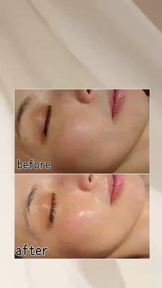 大人気!おすすめコースのご案内
幹細胞入りハーブピーリング
+
ぷるぷるコラーゲン入りモデリングパック
この豪華なセットメニューが
なんと初回限定で 11,000円 から
お試しいただけます!
通常価格 18,900円のところ
驚きの割引価格でご提供中です
美肌を手に入れるための最強コンボ!
幹細胞入りハーブピーリングで肌再生
コラーゲンモデリングパックでぷるぷる肌に仕上げ!
今すぐ予約して、理想の肌を手に入れましょう
#新丸子ハーブピーリング
#武蔵小杉小顔整体
#武蔵小杉ヒゲ脱毛
#武蔵小杉フォトフェイシャル