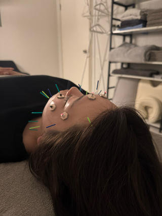 圧倒的人気の小顔矯正×美容鍼。 