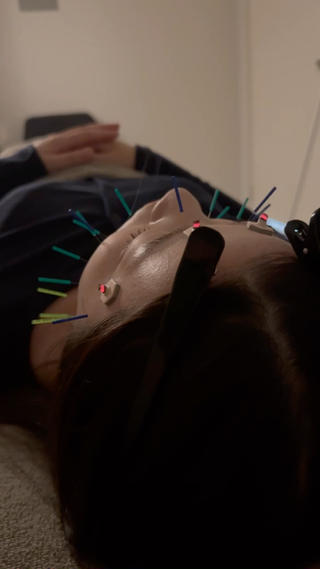 美容鍼でスッキリ小顔 