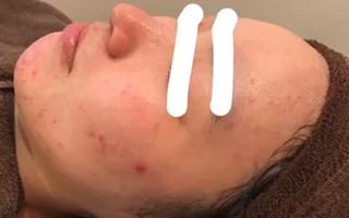 ハーブピーリング、before after動画
写真より、もっともっとbefore afterが
分かりやすいので、ぜひぜひご覧あれー
ディープクレンジング→濃密泡洗顔→ホットタオル→毛穴吸引→ハーブ導入→保湿+鎮静パック→お仕上げ、、、