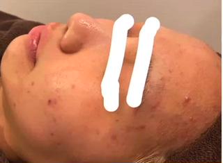 ハーブピーリング、before after動画
写真より、もっともっとbefore afterが
分かりやすいので、ぜひぜひご覧あれー
ディープクレンジング→濃密泡洗顔→ホットタオル→毛穴吸引→ハーブ導入→保湿+鎮静パック→お仕上げ、、、