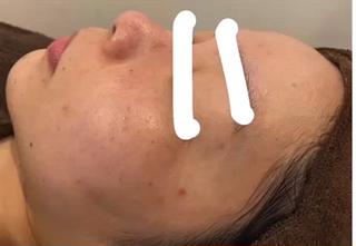 ハーブピーリング、before after動画
写真より、もっともっとbefore afterが
分かりやすいので、ぜひぜひご覧あれー
ディープクレンジング→濃密泡洗顔→ホットタオル→毛穴吸引→ハーブ導入→保湿+鎮静パック→お仕上げ、、、