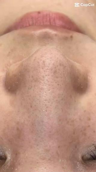 新技術毛穴洗浄
ダウンタイムなくその日からメイクできます 