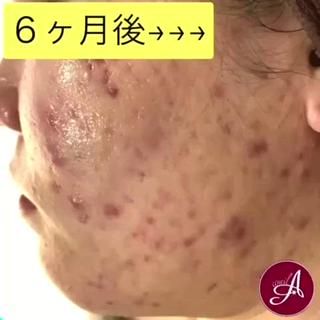 頑固なニキビ跡

個別改善プランでよくします 