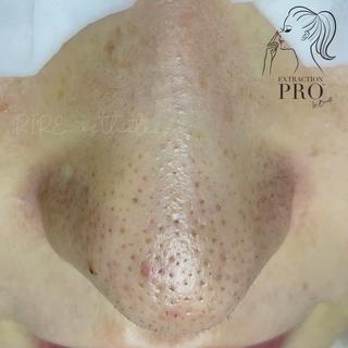 当店は、毛穴エクストラクションプロ認定サロン　です⠀
⠀
●毛穴エクストラクションとは？？⠀
⠀
長年の毛穴の黒ずみ、角栓つまり、しつこいザラつき皮脂詰まりなどを独自の方法でマシーンを使わず、毛穴ひとつひとつを観察しながら丁寧に取り除いていくとても繊細で高度なテクニックを要する毛穴ケア技術のことです。⠀
⠀
⠀
これまでの"毛穴エクストラクション"は、施術中に激しい痛みや赤みを伴う事も多く、施術後のヒリつき・赤み・剥離もひどく出てしまうため、それが苦手で毛穴の悩みを解消したいけれど諦めた、、、という他店経験のお客様のお声を耳にする事がありました。⠀
⠀
⠀
しかし、［毛穴エクストラクションプロ］は、プロとして、より安全で繊細な方法で行う事により、赤みや痛み、ヒリつきを可能な限り最小限にし、そして汚れを取り除いた後の毛穴引き締め・鎮静までもしっかり行うことで安心して受けて頂ける技術です⠀
⠀
⠀
これまで他店の毛穴エクストラクション、毛穴エステ、クリニックでのケア、自宅でのセルフケアで解消されなかった頑固な毛穴悩みは［毛穴エクストラクションプロ］にお任せください⠀
⠀
⠀
●毛穴エクストラクションプロ認定サロンとは？⠀
⠀
日本一厳しいと言われている毛穴専門エステスクール⠀
⠀
　@la.beaute.esthe(Instagram)⠀
⠀
の厳しいテストに合格し、合格者の中でも規定を満たしたプロフェッショナルなサロンのみが名乗ることができる称号です。⠀
⠀
このロゴマークがあるサロンのみが正規認定サロンとなります⠀
⠀
施術を受けたその日だけツルツルになればいい　のではなく、その後も効果を長く感じて頂け、お客様の毛穴のお悩みを確実に解消していくために、⠀
⠀
毛穴ケアのプロフェッショナルとして、お客様のあらゆる毛穴のお悩みと向き合い施術＋アドバイスさせて頂きますので、是非お任せください^ ^⠀
⠀
RIRE. (リール)esthetic:noriko⠀
⠀
#毛穴エクストラクションプロ認定サロン⠀
#毛穴エクストラクションプロ⠀
#毛穴エクストラクションプロ東京⠀
#毛穴エクストラクション⠀
#毛穴エクストラクション東京⠀
#エクストラクション⠀
#エクストラクション東京⠀
#エクストラクション毛穴⠀
#毛穴ケア#毛穴黒ずみ#毛穴開き 