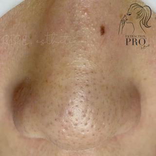 ----------------------------------⠀
⠀
当店は、毛穴エクストラクションプロ認定サロン　です⠀
⠀
●毛穴エクストラクションとは？？⠀
⠀
長年の毛穴の黒ずみ、角栓つまり、しつこいザラつき皮脂詰まりなどを独自の方法でマシーンを使わず、毛穴ひとつひとつを観察しながら丁寧に取り除いていくとても繊細で高度なテクニックを要する毛穴ケア技術のことです。⠀
⠀
⠀
これまでの"毛穴エクストラクション"は、施術中に激しい痛みや赤みを伴う事も多く、施術後のヒリつき・赤み・剥離もひどく出てしまうため、それが苦手で毛穴の悩みを解消したいけれど諦めた、、、という他店経験のお客様のお声を耳にする事がありました。⠀
⠀
⠀
しかし、［毛穴エクストラクションプロ］は、プロとして、より安全で繊細な方法で行う事により、赤みや痛み、ヒリつきを可能な限り最小限にし、そして汚れを取り除いた後の毛穴引き締め・鎮静までもしっかり行うことで安心して受けて頂ける技術です⠀
⠀
⠀
これまで他店の毛穴エクストラクション、毛穴エステ、クリニックでのケア、自宅でのセルフケアで解消されなかった頑固な毛穴悩みは［毛穴エクストラクションプロ］にお任せください⠀
⠀
⠀
●毛穴エクストラクションプロ認定サロンとは？⠀
⠀
日本一厳しいと言われている毛穴専門エステスクール⠀
⠀
　@la.beaute.esthe (Instagram)⠀
⠀
の厳しいテストに合格し、合格者の中でも規定を満たしたプロフェッショナルなサロンのみが名乗ることができる称号です。⠀
⠀
このロゴマークがあるサロンのみが正規認定サロンとなります⠀
⠀
施術を受けたその日だけツルツルになればいい　のではなく、その後も効果を長く感じて頂け、お客様の毛穴のお悩みを確実に解消していくために、⠀
⠀
毛穴ケアのプロフェッショナルとして、お客様のあらゆる毛穴のお悩みと向き合い施術＋アドバイスさせて頂きますので、是非お任せください^ ^⠀
⠀
----------------------------------⠀
RIRE.esthetic(リール エステティック)⠀
⠀
ご予約ご希望の方は、3枚目の「同意書」をご一読いただきご了承頂いてからご連絡お願いいたします⠀
⠀
ご予約は、DM or 公式LINEより、⠀
・お名前⠀
・お電話番号⠀
・ご希望の日時(メニュー、商品)を⠀
メッセージくださいませ⠀
⠀
東京都八王子市⠀
明神町1-11-22 メゾン八王子203号室⠀
京王線　京王八王子駅　徒歩8分⠀
JR線　八王子駅　徒歩18分⠀
最寄りバス停　「明神町」　徒歩7分⠀
⠀
駐車場はございません。⠀
近くのコインパーキング情報⠀
     八王子市明神町2-11-8⠀
     →30分200円(徒歩3分)⠀
     八王子市明神町2-15-7⠀
     →40分100円(徒歩4分)⠀
     八王子市明神町2-12-12⠀
     →40分200円(徒歩4分)⠀
⠀
⠀
営業時間→10:00〜19:00⠀
定休日→不定休⠀
⠀
---------------------------------- ⠀
⠀
#毛穴エクストラクションプロ認定サロン⠀
#毛穴エクストラクションプロ⠀
#毛穴エクストラクションプロ東京⠀
#毛穴エクストラクション⠀
#毛穴エクストラクション東京⠀
#毛穴エクストラクション八王子⠀
#エクストラクション⠀
#エクストラクション東京⠀
#エクストラクション毛穴⠀
#毛穴ケア#毛穴黒ずみ#毛穴開き⠀
#化粧品難民 #化粧品 #エステサロン #肌荒れ #肌質改善 #メイク #ボディケア #エステ #洗顔 #美肌 #ビフォーアフター#美容知識　#美容マニア　#美肌ケア #ハーブピーリング #碧ハーブピーリング #ニキビ #ニキビ跡⠀
⠀
---------------------------------- 