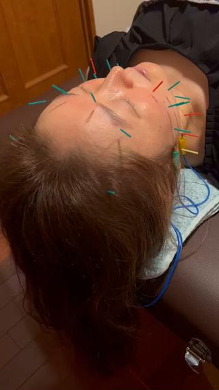 基本美容鍼パルス
〜ゆっくりめの電気鍼刺激でリラックスを〜
筋肉の硬さや希望効果、目的により刺激量を調整しております^ ^ 