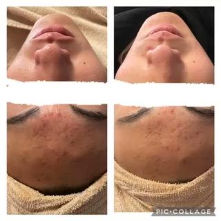 ニキビ潰してしまった後のクレーターにも！剥離有りハーブピーリング1回で赤みがかなり落ち着きました！ 