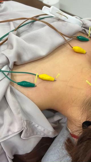 身体にも鍼を打ってます♪ 