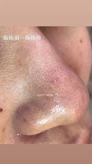 いつの間にか黒ずんできた毛穴⋯

ギトギトベタベタから、スッキリツヤツヤに️

一度の施術で効果実感！！

月1回お手入れを続けることで、

綺麗をずーっとキープしていきましょう 