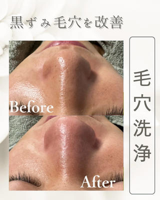 \立川駅徒歩2分/
水流と吸引の力で毛穴の奥に詰まった
角栓・皮脂・黒ずみをしっかり除去

 いちご鼻改善
 毛穴のざらつきゼロ
 開いた毛穴をキュッと引き締め

毛穴の大掃除＋美容成分導入で、
つるんとした透明感あふれる素肌へ

毛穴洗浄
イオン導入
しわたるみケア
ニキビ、ニキビ跡ケア

【BUB 立川店】
ユニセックスサロン

▼アクセス

東京都立川市柴崎町3−８ー７
アーバンカサイ３０２

#毛穴#毛穴洗浄#毛穴ケア#いちご鼻#角栓

 