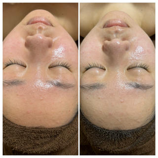陶肌トリートメントでなりたいお肌へ。
ご新規様、ニキビ、ざらつき、ごわつきなどに長年お悩みで勇気を出してご予約ご来店くださいました！
ニキビは繰り返すので継続が必要ですが必ずキレイになります！初回はトーンアップやもちもち感を実感してもらえました。お肌のお悩みお任せください 