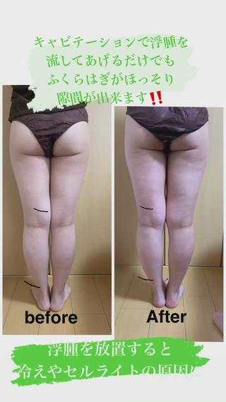 他店は一部位のみのキャビテーションだったりしますが
当店は下半身なら下半身がっつり
全部に当てていきます
